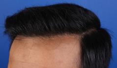 Before Hair Transplant&nbsp;Front